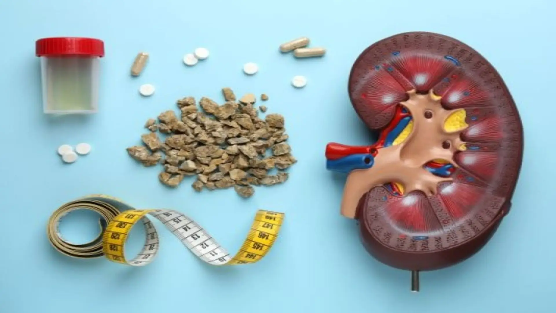 How to Pass a Kidney Stone: 5 Effective Tips to Prevent Them